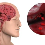 40 વર્ષથી ઓછી ઉંમરના લોકોમાં પણ મગજના સ્ટ્રોક થઈ રહ્યા છે, ડોક્ટરોએ આ ત્રણ મુખ્ય કારણો આપ્યા છે